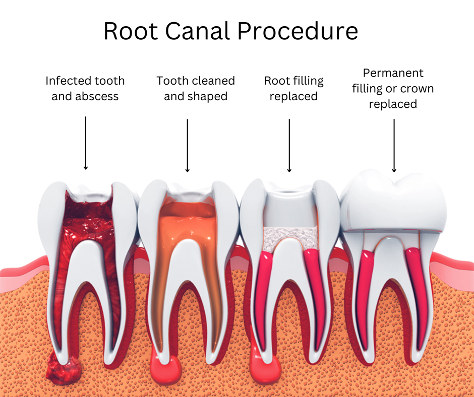 RootCanal