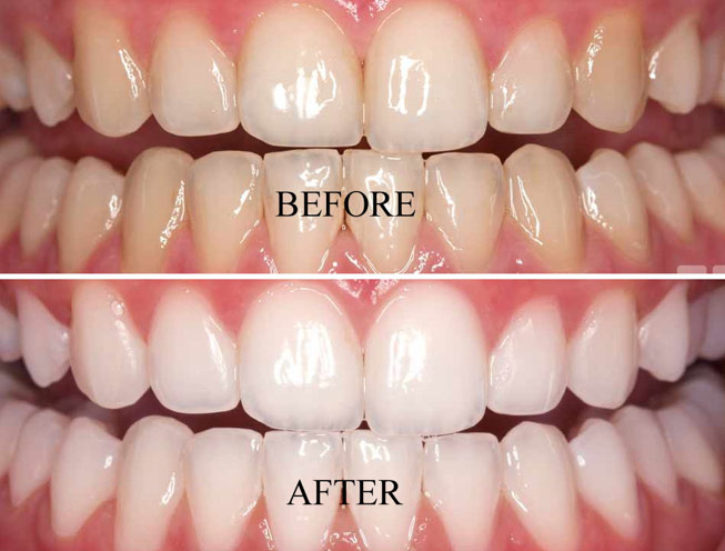 TeethWhitening